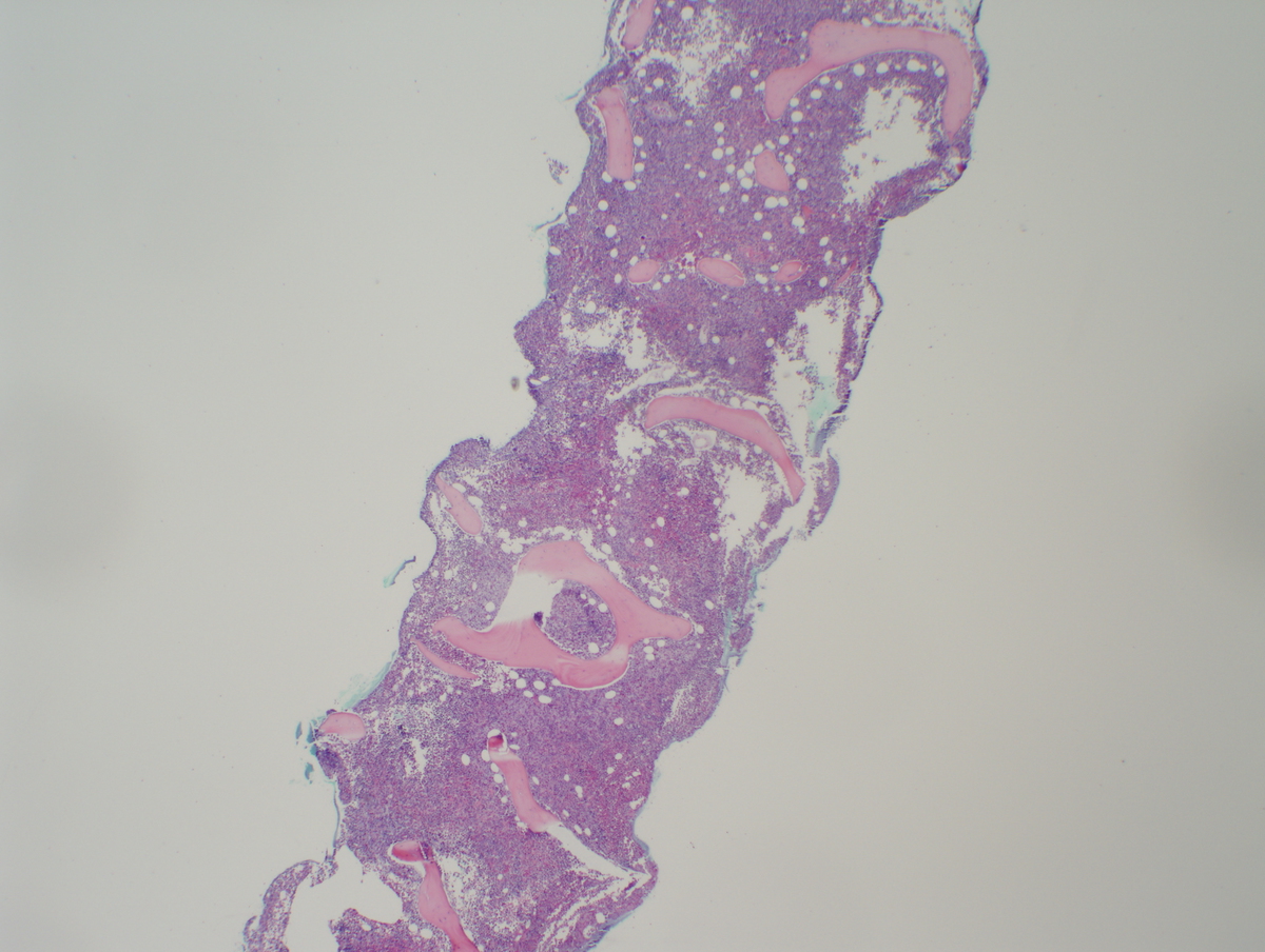 Bone marrow trephine biopsy (2x)
